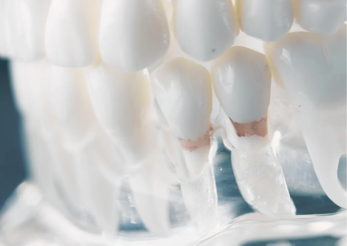 Dental model showing plaque buildup along the gumline and between teeth before removal.