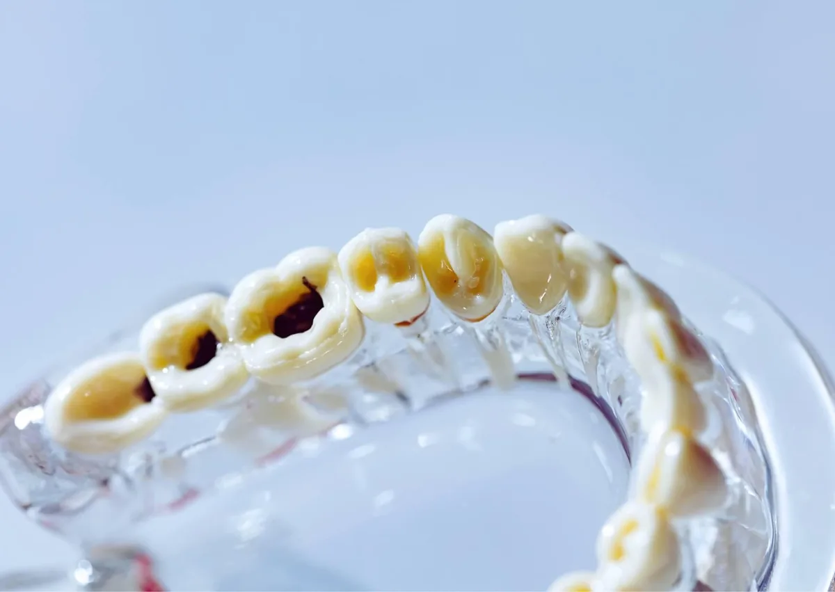 Dental model showing visible cavities and tooth decay at different stages of development.